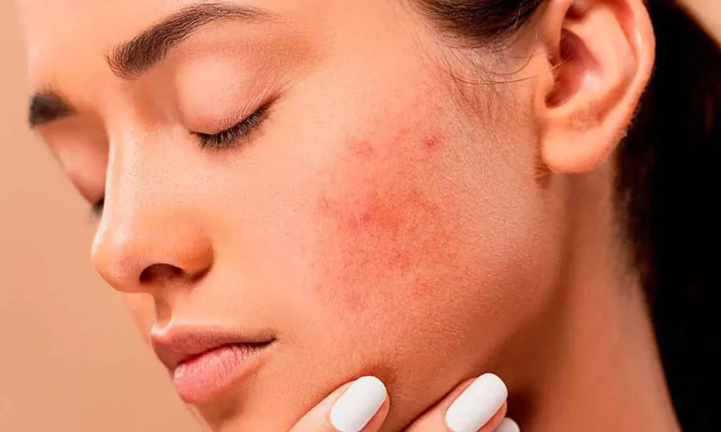 Dermatitis facial y jabón de azufre