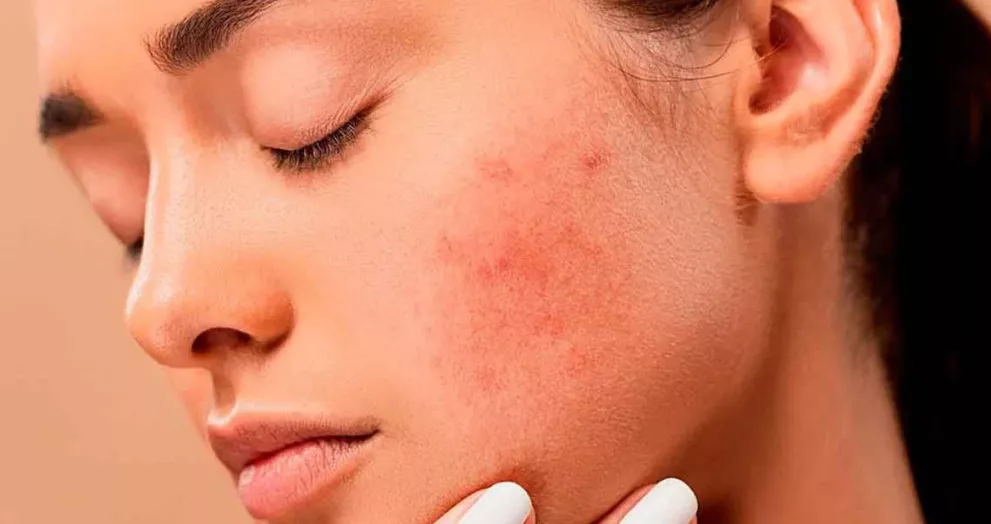 Dermatitis facial y jabón de azufre